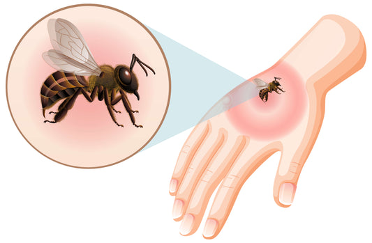 Should I be worried about a bee sting while pregnant? Beezzit