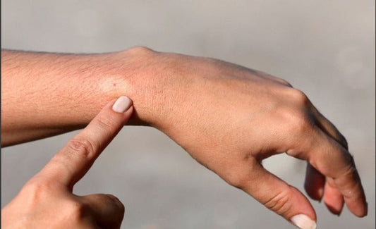 What to do after a bee bite? Beezzit